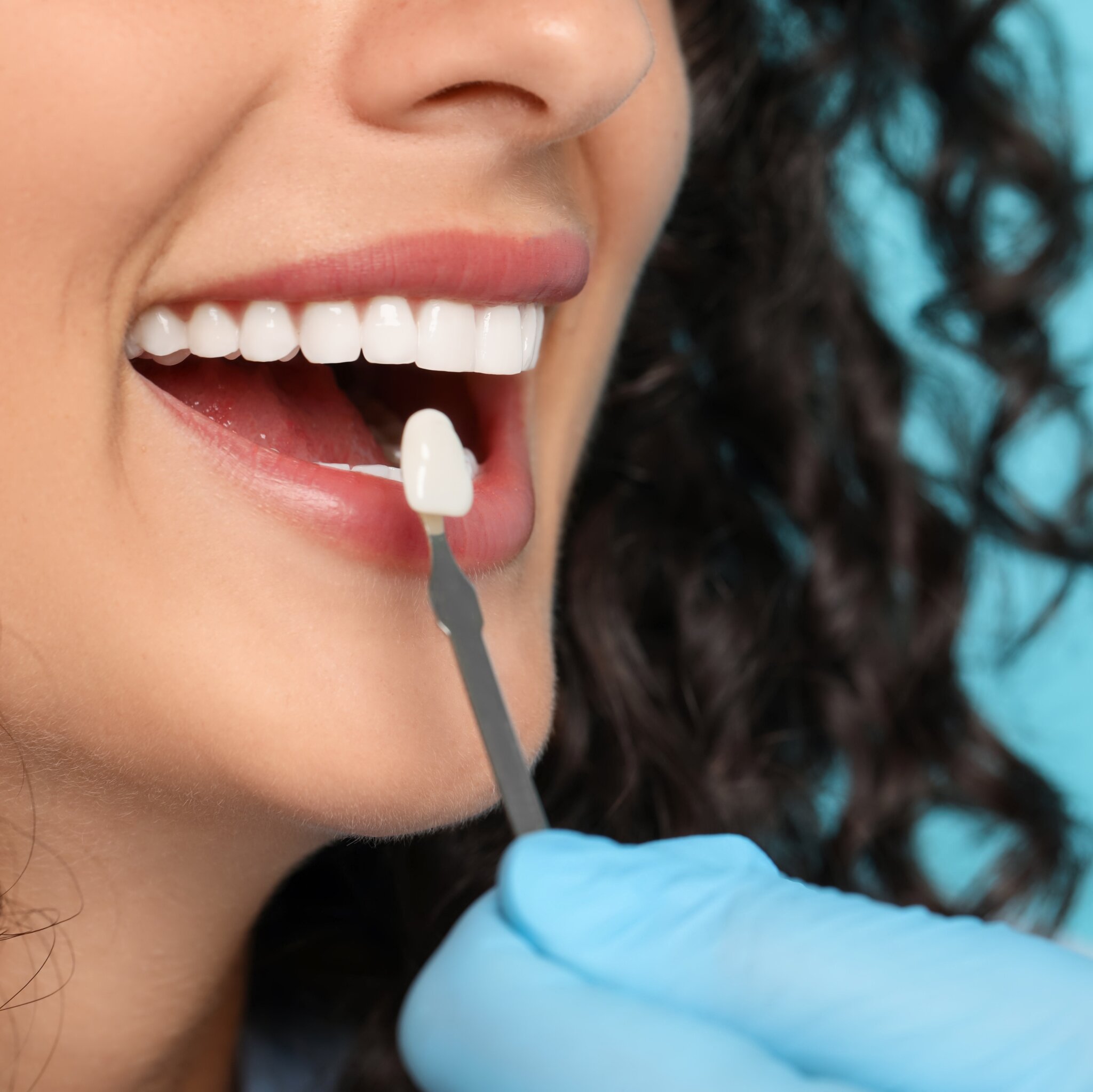 Зубные виниры - ERA ESTHETIC DENTAL